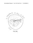 MEDICAL DEVICE, KIT AND METHOD FOR CONSTRICTING TISSUE OR A BODILY     ORIFICE, FOR EXAMPLE, A MITRAL VALVE diagram and image