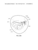 MEDICAL DEVICE, KIT AND METHOD FOR CONSTRICTING TISSUE OR A BODILY     ORIFICE, FOR EXAMPLE, A MITRAL VALVE diagram and image