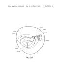 MEDICAL DEVICE, KIT AND METHOD FOR CONSTRICTING TISSUE OR A BODILY     ORIFICE, FOR EXAMPLE, A MITRAL VALVE diagram and image