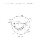 MEDICAL DEVICE, KIT AND METHOD FOR CONSTRICTING TISSUE OR A BODILY     ORIFICE, FOR EXAMPLE, A MITRAL VALVE diagram and image