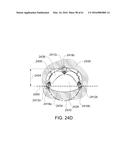 MEDICAL DEVICE, KIT AND METHOD FOR CONSTRICTING TISSUE OR A BODILY     ORIFICE, FOR EXAMPLE, A MITRAL VALVE diagram and image