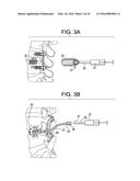 Aspirating Implants and Method of Bony Regeneration diagram and image