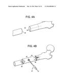 Aspirating Implants and Method of Bony Regeneration diagram and image