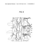 Aspirating Implants and Method of Bony Regeneration diagram and image