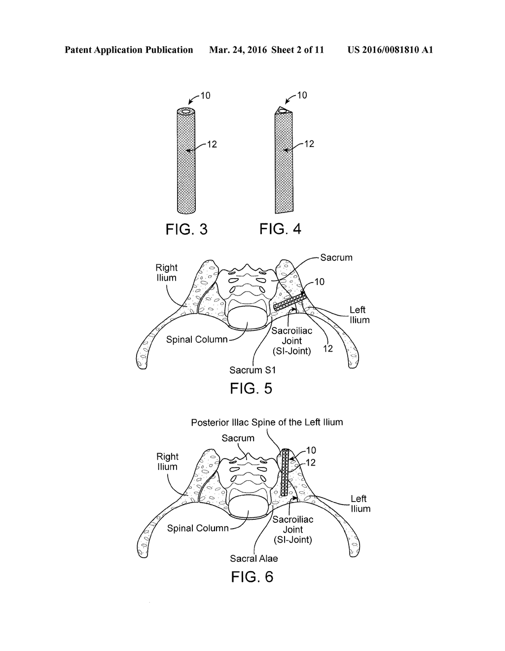 IMPLANTS FOR BONE FIXATION OR FUSION - diagram, schematic, and image 03