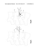 DISTRACTIBLE INTERVERTEBRAL IMPLANT diagram and image