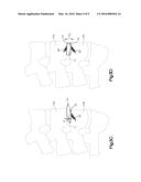 DISTRACTIBLE INTERVERTEBRAL IMPLANT diagram and image