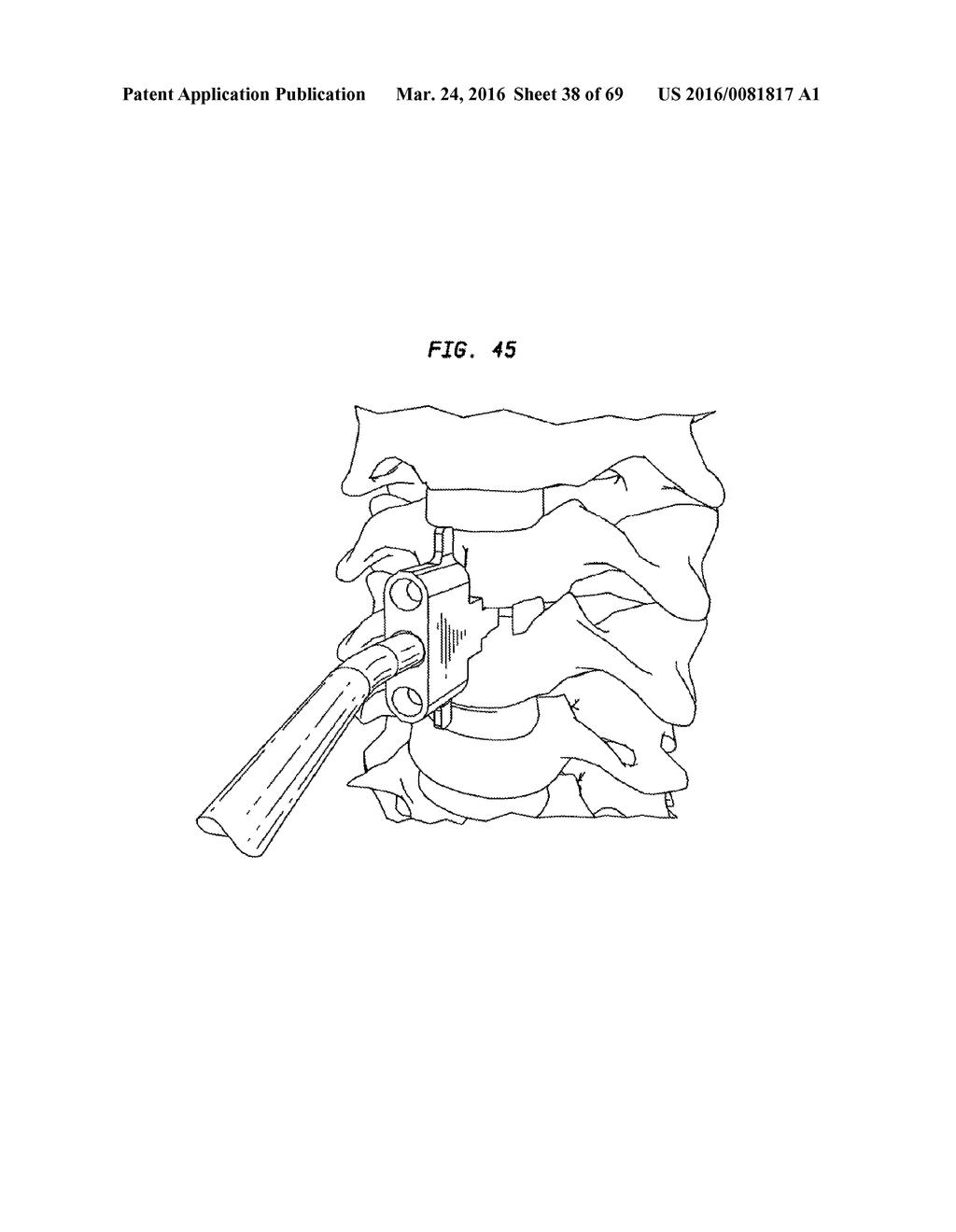 INTERVERTEBRAL DISC AND INSERTION METHODS THEREFOR - diagram, schematic, and image 39