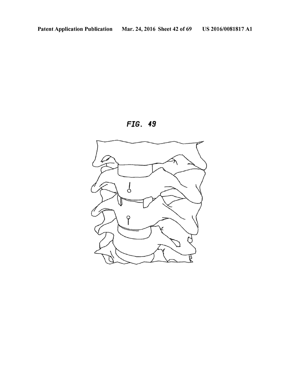 INTERVERTEBRAL DISC AND INSERTION METHODS THEREFOR - diagram, schematic, and image 43