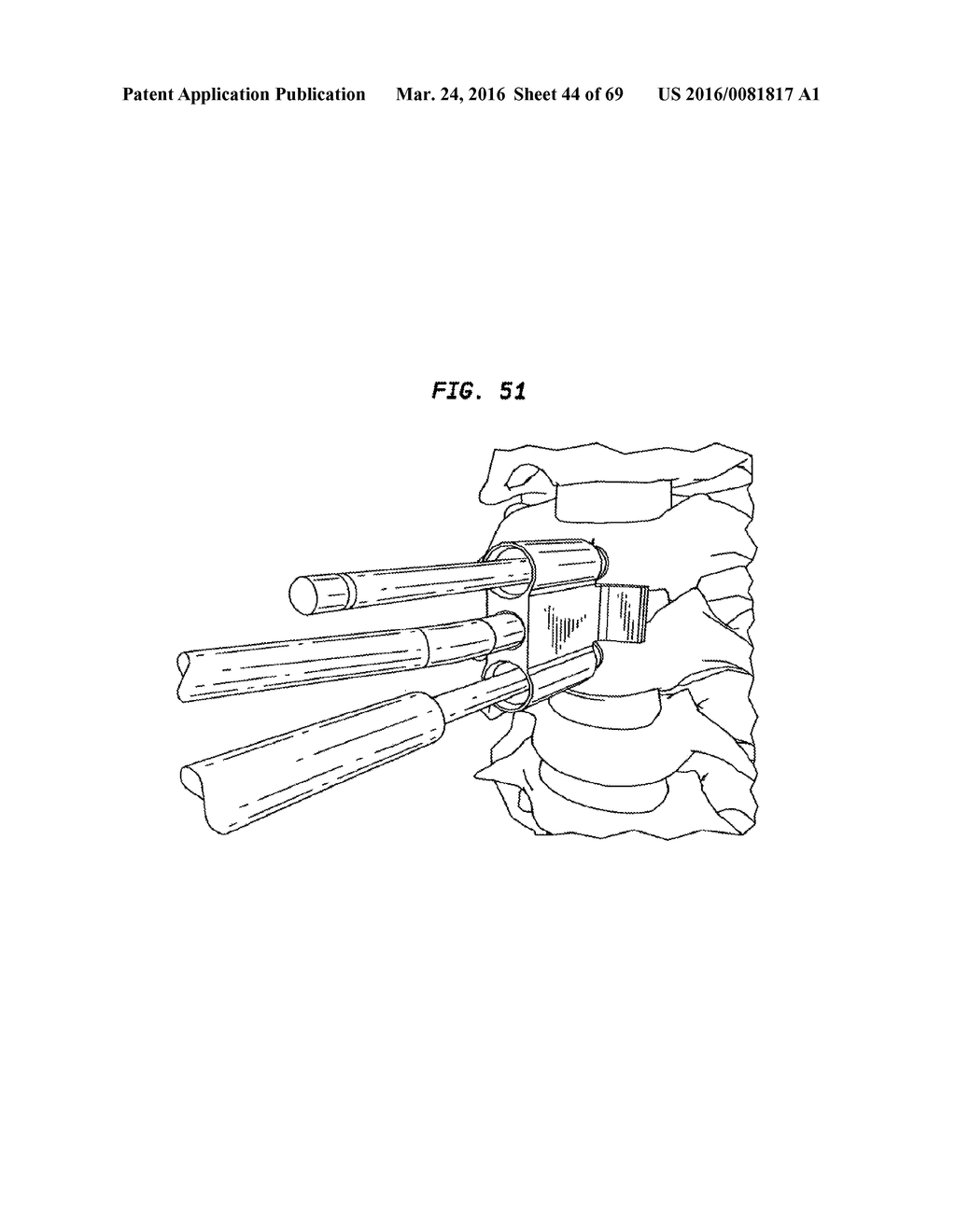 INTERVERTEBRAL DISC AND INSERTION METHODS THEREFOR - diagram, schematic, and image 45