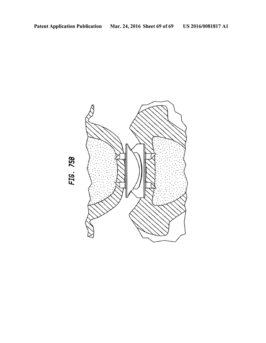 INTERVERTEBRAL DISC AND INSERTION METHODS THEREFOR - diagram, schematic, and image 70