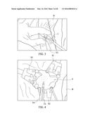 SPINAL IMPLANT SYSTEM AND METHOD FOR LUMBAR AND LUMBOSACRAL FUSION diagram and image