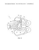 SPINAL IMPLANT SYSTEM AND METHOD FOR LUMBAR AND LUMBOSACRAL FUSION diagram and image