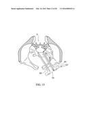 SPINAL IMPLANT SYSTEM AND METHOD FOR LUMBAR AND LUMBOSACRAL FUSION diagram and image