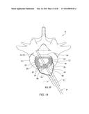 SPINAL IMPLANT SYSTEM AND METHOD FOR LUMBAR AND LUMBOSACRAL FUSION diagram and image