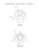 SPINAL IMPLANT SYSTEM AND METHOD FOR LUMBAR AND LUMBOSACRAL FUSION diagram and image