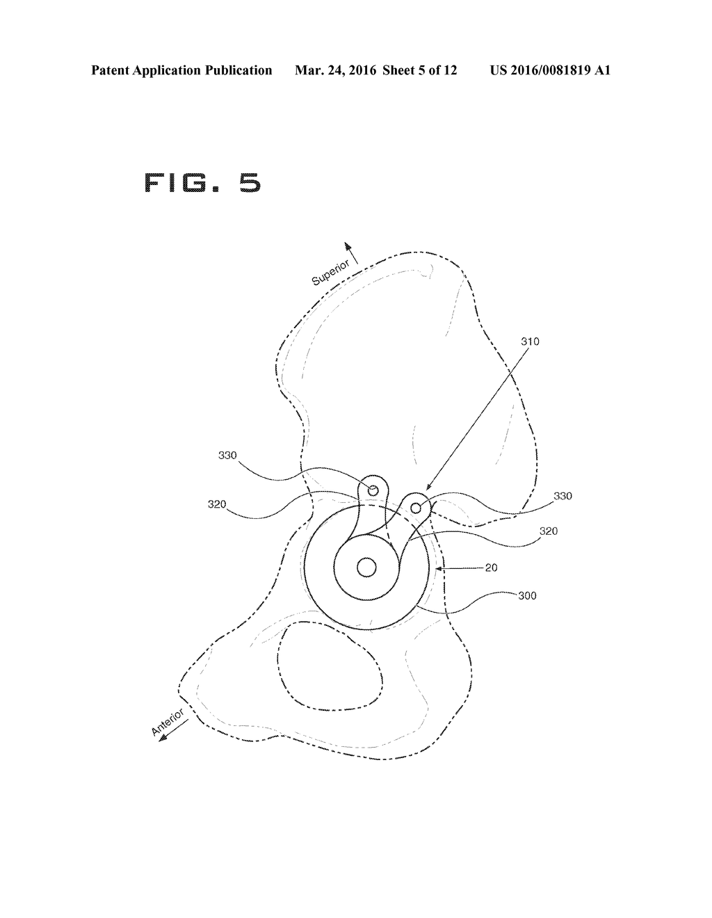 ACETABULAR IMPLANT ALIGNMENT DEVICES AND METHODS - diagram, schematic, and image 06