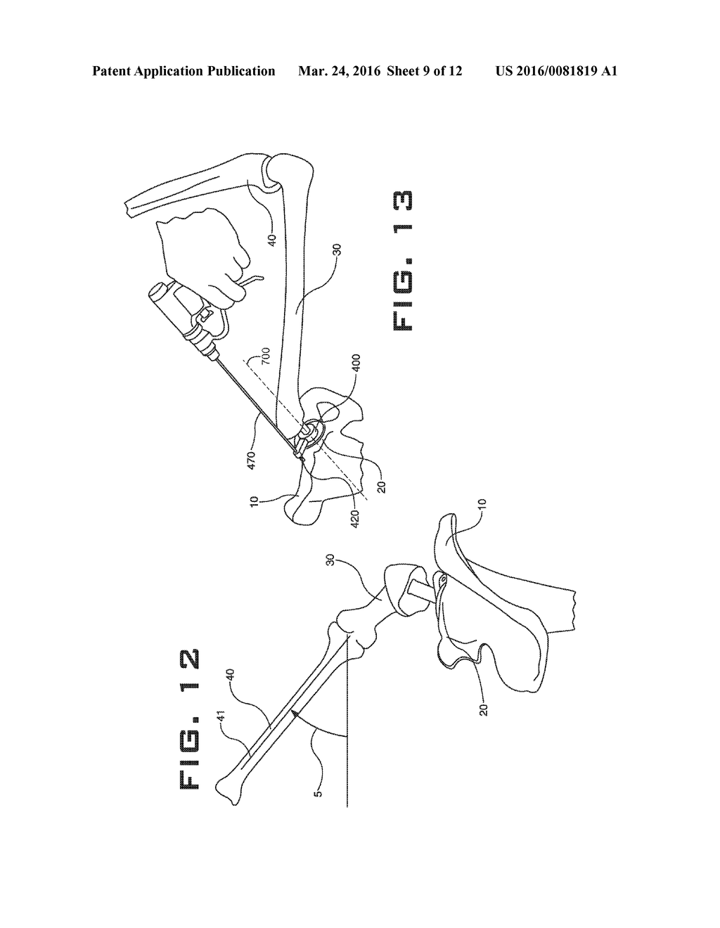 ACETABULAR IMPLANT ALIGNMENT DEVICES AND METHODS - diagram, schematic, and image 10