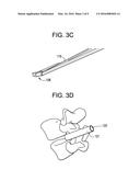 MINIMALLY INVASIVE INTERVERTEBRAL STAPLE DISTRACTION DEVICES diagram and image