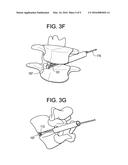 MINIMALLY INVASIVE INTERVERTEBRAL STAPLE DISTRACTION DEVICES diagram and image