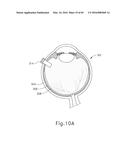 THERAPEUTIC AGENT DELIVERY DEVICE diagram and image