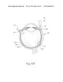 THERAPEUTIC AGENT DELIVERY DEVICE diagram and image