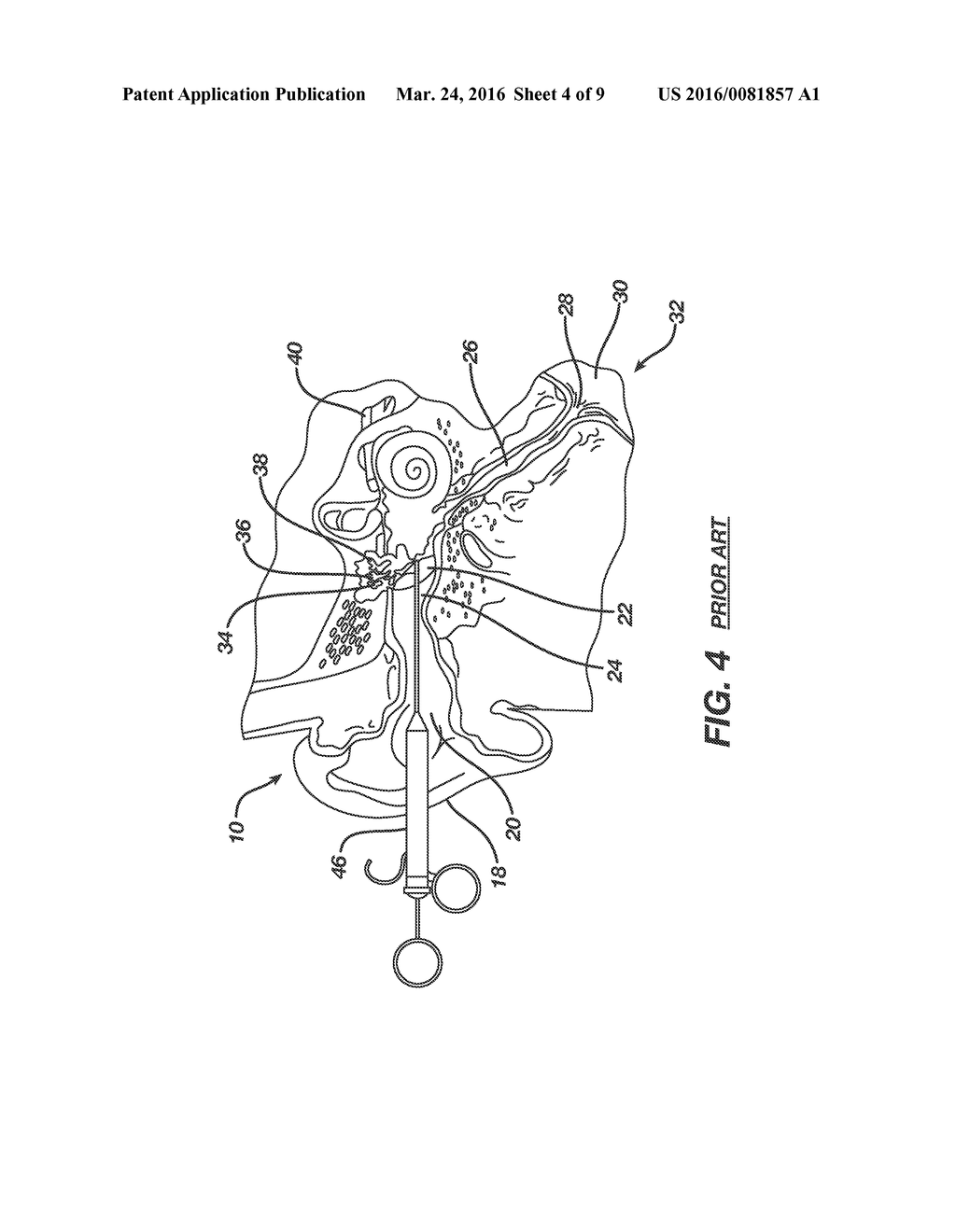 Low Profile Eustachian Tube Dilation System - diagram, schematic, and image 05