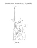  Dual Lumen Cannula  diagram and image