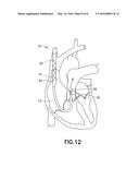  Dual Lumen Cannula  diagram and image