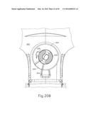 BALLOON CATHETER ASSEMBLY diagram and image