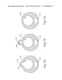 BALLOON CATHETER ASSEMBLY diagram and image