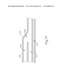 BALLOON CATHETER ASSEMBLY diagram and image