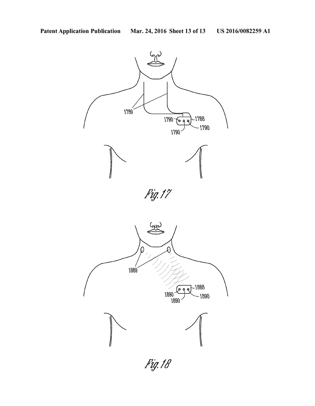 CLOSED LOOP NEURAL STIMULATION SYNCHRONIZED TO CARDIAC CYCLES - diagram, schematic, and image 14