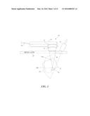 ULTRASOUND BASED METHOD AND APPARATUS FOR STONE DETECTION AND TO     FACILITATE CLEARANCE THEREOF diagram and image