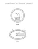 Non-Metal and Hybrid Bottle Crowns With Opener Assembly diagram and image