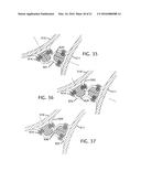 FREE FLOATING INTEGRATED LUG BRIDGE diagram and image