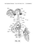 FREE FLOATING INTEGRATED LUG BRIDGE diagram and image