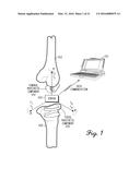 Prosthetic Knee Joint Measurement System Including Energy Harvesting And     Method Therefor diagram and image