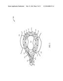 ENERGY-BASED LYMPH NODE DISSECTION DEVICE diagram and image