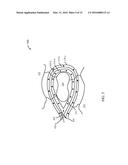 ENERGY-BASED LYMPH NODE DISSECTION DEVICE diagram and image