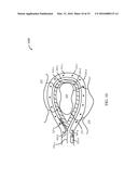 ENERGY-BASED LYMPH NODE DISSECTION DEVICE diagram and image