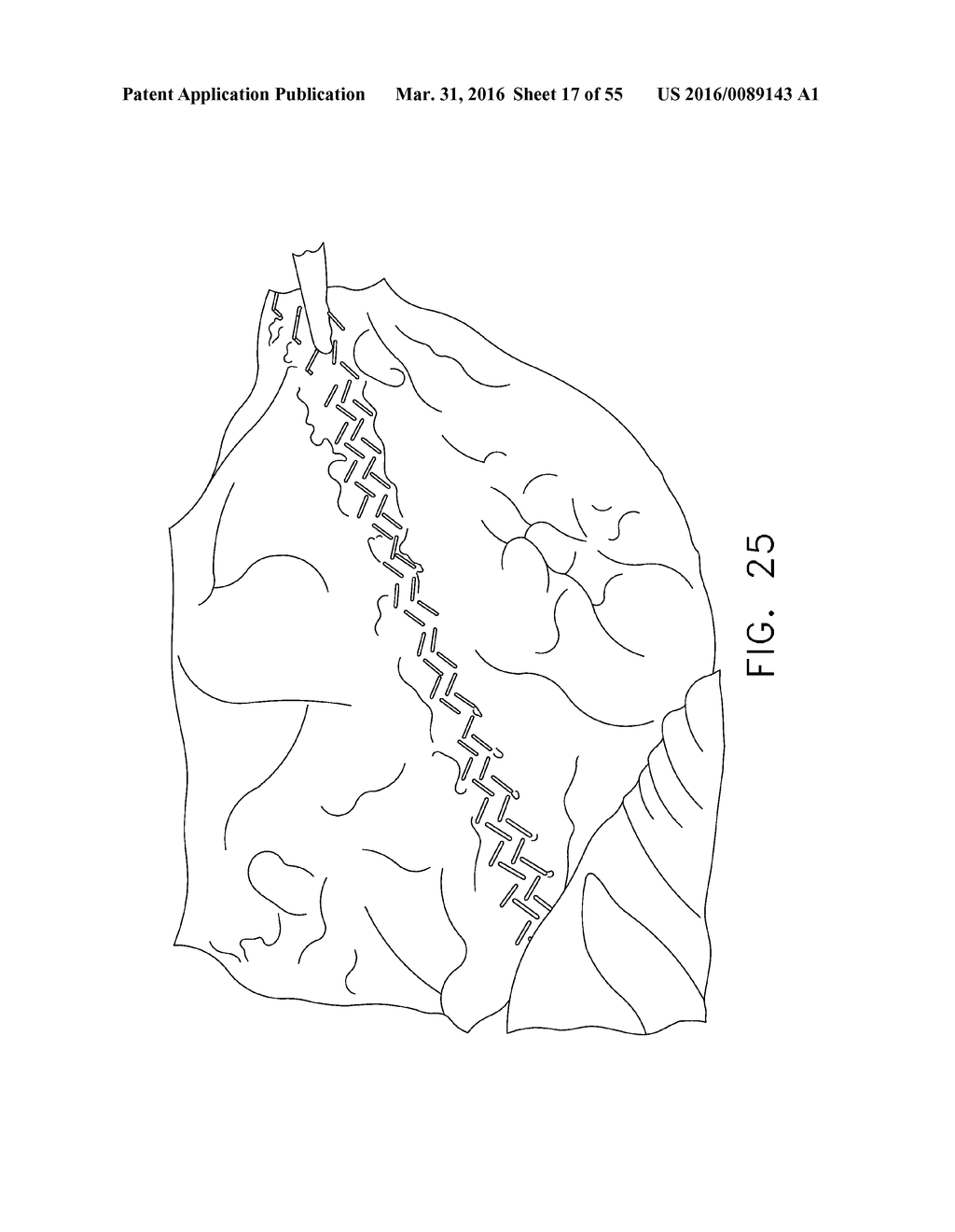 SURGICAL STAPLING BUTTRESSES AND ADJUNCT MATERIALS - diagram, schematic, and image 18