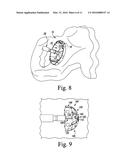 ORTHOPAEDIC SURGICAL INSTRUMENT ASSEMBLY AND METHOD OF MANUFACTURING SAME diagram and image