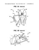 Side-Loading Carriage for Use in Surgical Guide diagram and image