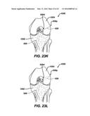 Side-Loading Carriage for Use in Surgical Guide diagram and image