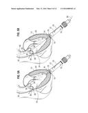 SURGICAL STABILIZER AND CLOSURE SYSTEM diagram and image