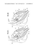 SURGICAL STABILIZER AND CLOSURE SYSTEM diagram and image