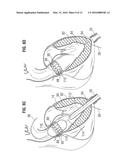 SURGICAL STABILIZER AND CLOSURE SYSTEM diagram and image