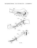 INTRAMEDULLARY FRACTURE FIXATION DEVICES AND METHODS diagram and image