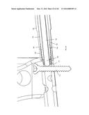 INTRAMEDULLARY FRACTURE FIXATION DEVICES AND METHODS diagram and image